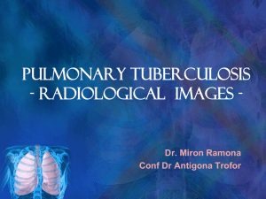 Pulmonary TB radiology