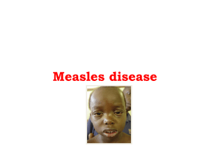 -1- Measles disease