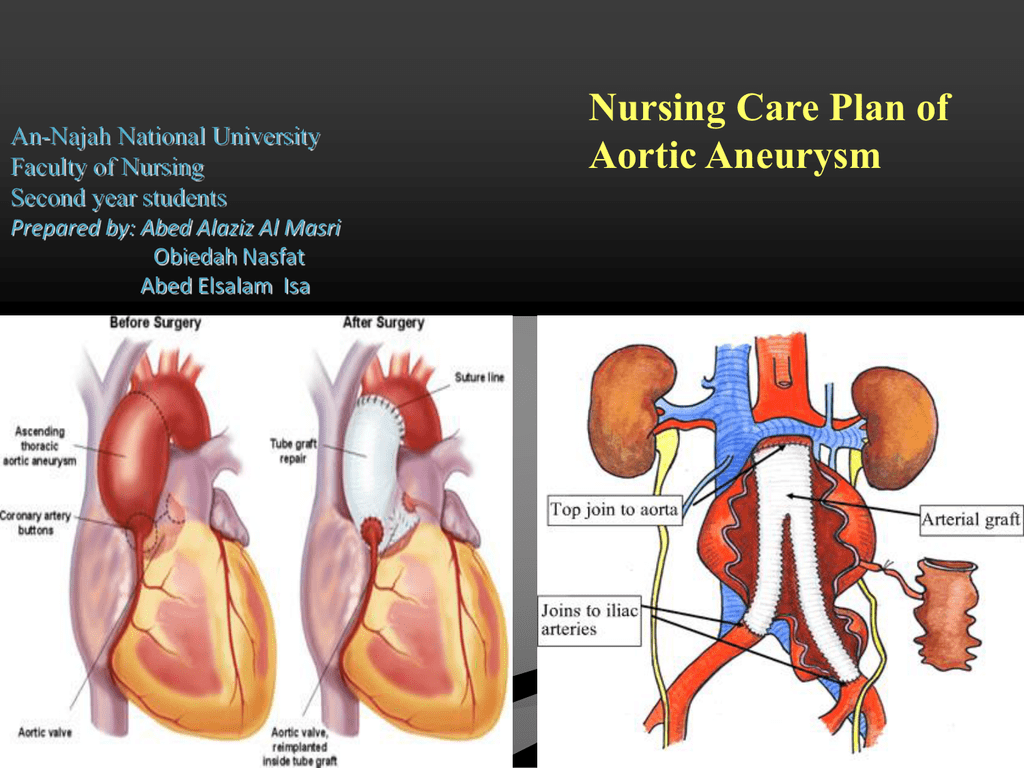 NCP Nursing Care Plan For Abdominal Aortic Aneurysm Super Daily News