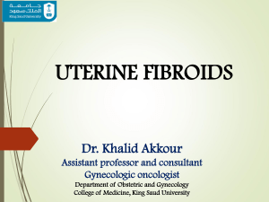15-Uterine Fibroids