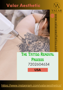 The Tattoo Removal Process