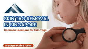 Your Solution for Skin Tag and Sebaceous Cyst Problems in Singapore