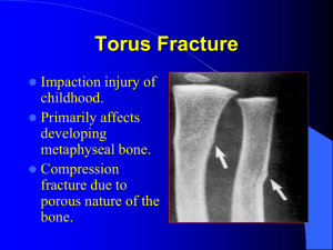 Torus Fracture