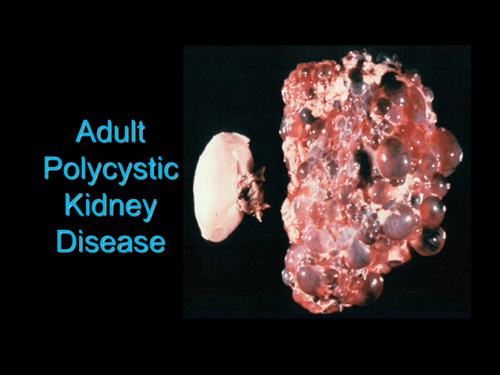 Adult Polycystic Kidney Disease