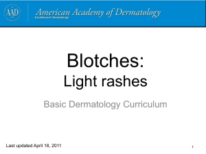 Seborrheic dermatitis - American Academy of Dermatology