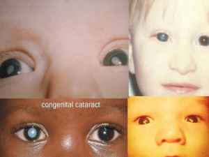 Congenital-cataract