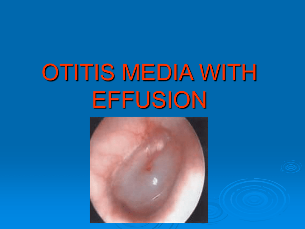 Otitis Media With Effusion : Otitis Media With Effusion Of The Right