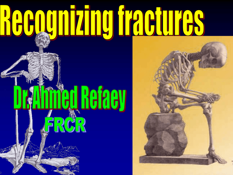 Fracture Meaning In English