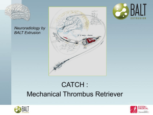 CATCH : Mechanical Thrombus Retriever