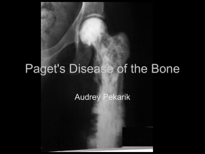 Paget`s Disease