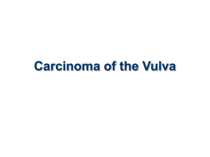 Carcinoma of the Vulva for undergraduate students