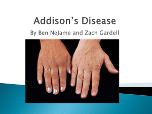 Addison`s Disease