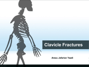 Clavicle Fractures Clavicle Fractures
