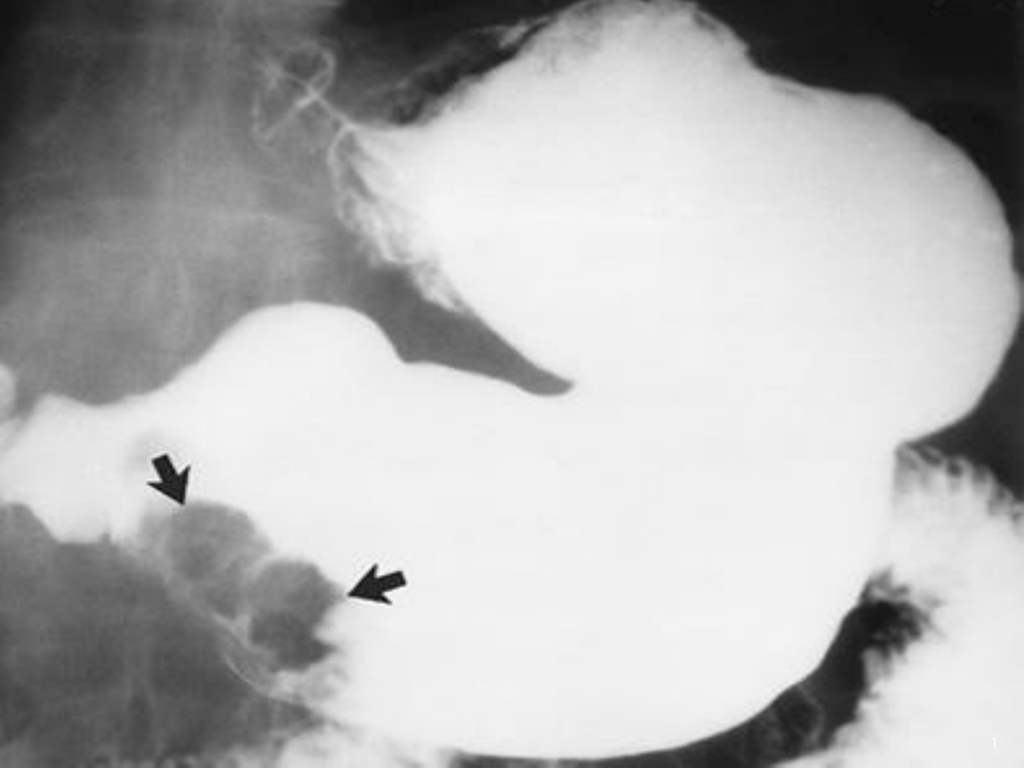 Диффузный антральный. Стеноз 12 перстной кишки рентген. Малигнизированная язва желудка рентген. Язва кардиального отдела желудка рентген. Неоплазия желудка на рентгене.