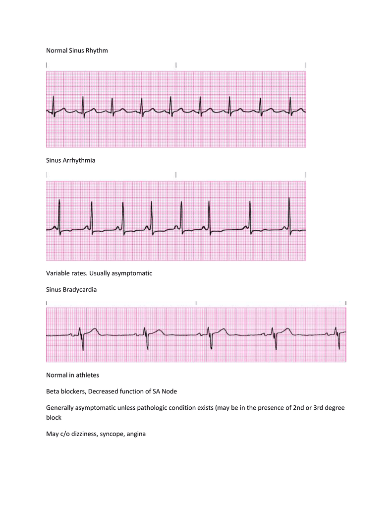 irregular heart rate