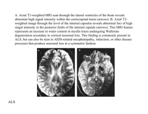 A. Axial T2-weighted MRI scan through the lateral ventricles of... abnormal high signal intensity within the corticospinal tracts (arrows). B....