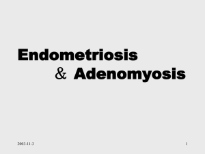 Endometeriosis1