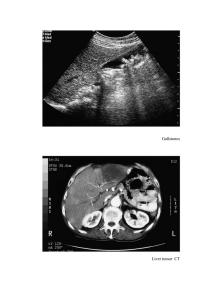 Gallstones Liver tumor  CT