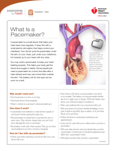What Is a Pacemaker? - American Heart Association