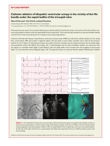 Catheter ablation of idiopathic ventricular ectopy in the vicinity of the