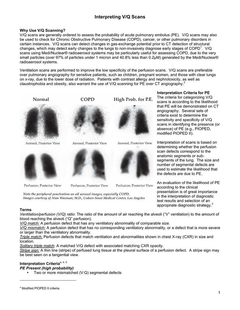 Modified Pioped Ii Criteria Chart