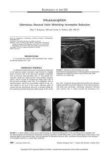 Intussusception