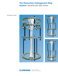 The Distraction Osteogenesis Ring System. Nonarticular tibia frame.