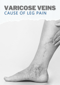 Varicose Veins- Cause of Leg Pain