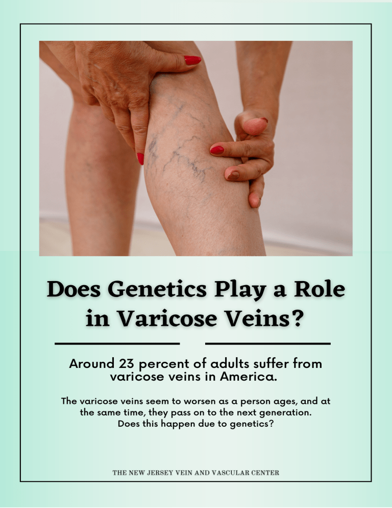 does-genetics-play-a-role-in-varicose-veins