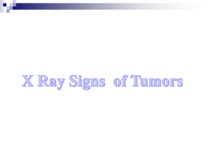 X ray sign of tumor