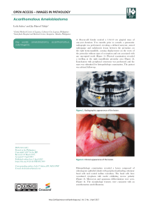 Acanthomatous Ameloblastoma Case Study