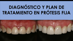 Diagn&oacute;stico y Plan de Tratamiento en Pr&oacute;tesis Fija