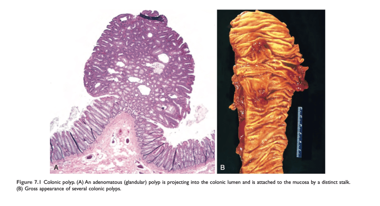 Colonic Crypt Polyp Colonic Polyps: Histology & Gross Pathology in Medical Education